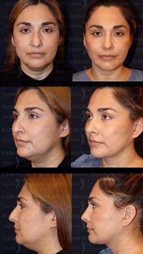 Jason Champagne, M.D. | In this before and after, my patient is just two months post-op from her facelift, neck lift, and rhinoplasty, performed as part of her... | Instagram