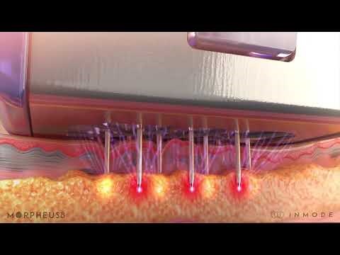 Morpheus8 Radiofrequency Microneedling