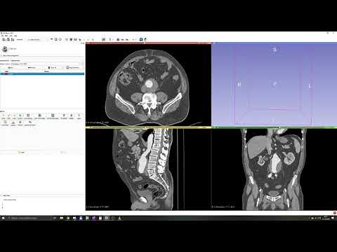 3D Slicer Tutorial #2: Manual segmentation. Thresholding.