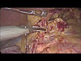 Laparoscopic Distal Gastrectomy with D2 Lymph Node Dissection for Cancer  • Video • MEDtube.net