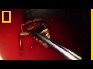 A Cockroach Crawled Inside a Woman's Head. See How a Doctor Got it Out. | National Geographic