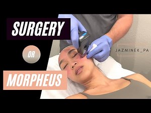 MORPHEUS 8 Procedure Experience