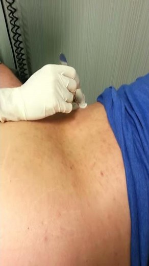 EXTREME Cyst Removing - Exploding with Blood and Chunks