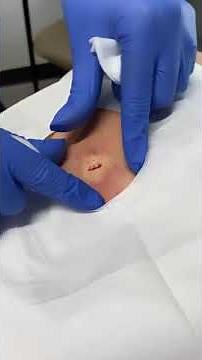 The Best Pimple Popper Video Ever! This Cyst Exploded!
