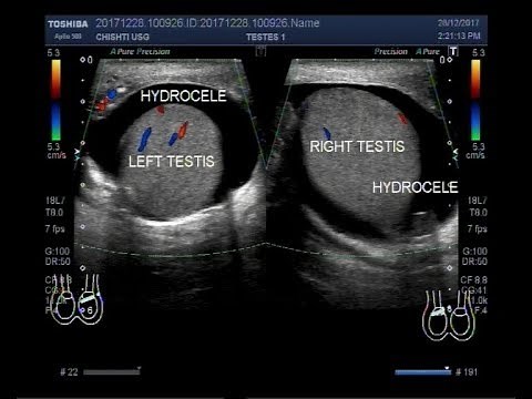 Ultrasound Video showing bilateral testicular Hydrocele.