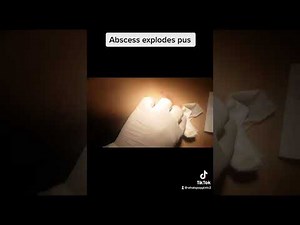 Abscess explodes pus