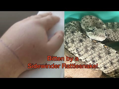 Sidewinder Rattlesnake Bite
