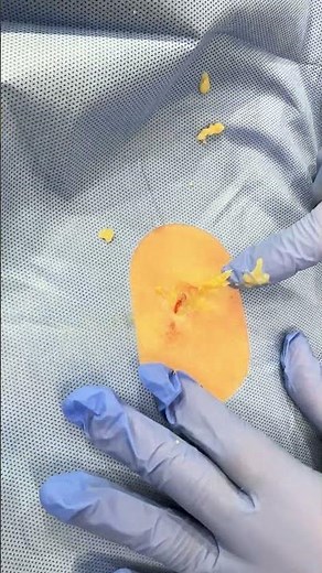 Watch Out, Splash Zone Cyst! | Dr. Derm