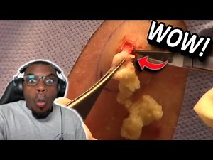 LOOK AT THIS EXPLODING CYST POP! | Dr. Derm REACTION!