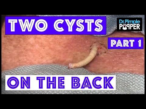 WEB EXCLUSIVE: Cysts Removed from the Back.. Two of 'em! (1 of 2)