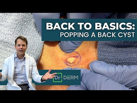 SATISFYING Back Cyst Removal From Start To Finish! | Dr. Derm