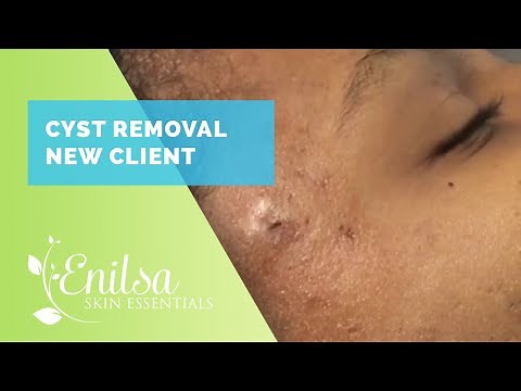 Cyst Removal New Client