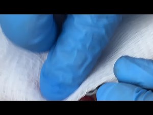 Massive Cyst on Back Explodes with Pus During Removal!