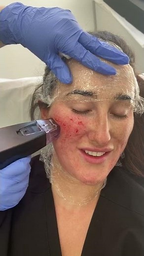 MORPHEUS8 for skin tightening