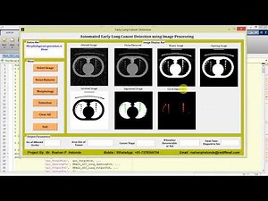 Matlab Project for Early Lung Cancer Detection Using Image Processing Full Source Code