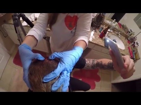 At Home Pilar Cyst Removal
