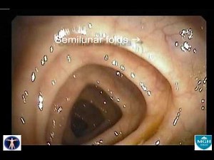 A Normal Colonoscopy