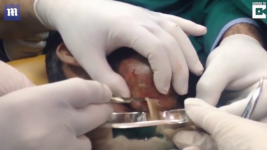 Graphic video shows surgeon popping huge abscess on man's jaw