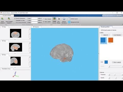3D Image Segmentation of Brain Tumors Using Deep Learning